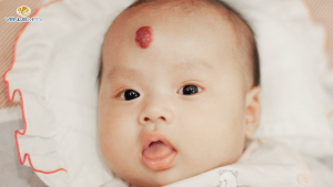 Chàm bớt có nguy hiểm không