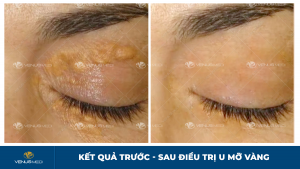 Hiệu quả chữa u mỡ vàng bằng công nghệ RFA