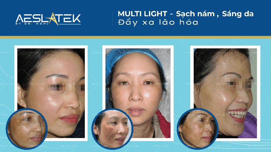 Hình ảnh khách hàng điều trị nám bằng phương pháp Laser trị nám thế hệ 3 - Multi-Light®