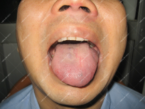 Kết quả điều trị dị dạng tĩnh mạch ở lưỡi bằng Laser Nd:YAG 4