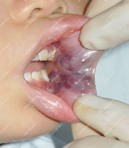 Nghiên cứu điều trị các tổn thương nông của dị dạng tĩnh mạch trong khoang miệng bằng laser kết hợp với làm xẹp mạch dãn 1