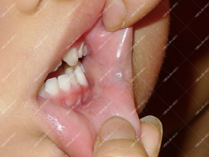 Nghiên cứu điều trị các tổn thương nông của dị dạng tĩnh mạch trong khoang miệng bằng laser kết hợp với làm xẹp mạch dãn 2
