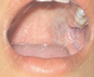 Nghiên cứu điều trị các tổn thương nông của dị dạng tĩnh mạch trong khoang miệng bằng laser kết hợp với làm xẹp mạch dãn 10