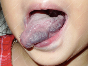 Kết quả điều trị dị dạng tĩnh mạch ở lưỡi bằng Laser Nd:YAG 7