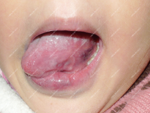 Điều trị dị dạng tĩnh mạch ở lưỡi bằng Laser 8