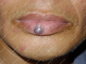 Điều trị dị dạng hồ tĩnh mạch ở niêm mạc môi đỏ bằng laser Nd:YAG 1