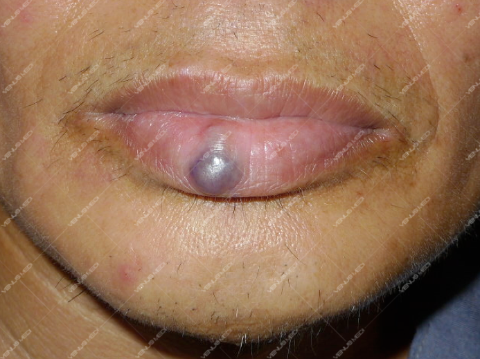 Điều trị dị dạng hồ tĩnh mạch ở niêm mạc môi đỏ bằng laser Nd:YAG