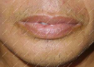 Điều trị dị dạng hồ tĩnh mạch ở niêm mạc môi đỏ bằng laser Nd:YAG 2