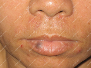 Điều trị dị dạng hồ tĩnh mạch ở niêm mạc môi đỏ bằng laser Nd:YAG 3