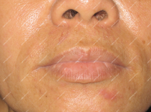 Điều trị dị dạng hồ tĩnh mạch ở niêm mạc môi đỏ bằng laser Nd:YAG 4