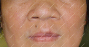 Điều trị dị dạng hồ tĩnh mạch ở niêm mạc môi đỏ bằng laser Nd:YAG 6
