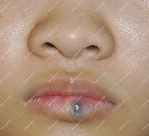 Điều trị dị dạng hồ tĩnh mạch ở niêm mạc môi đỏ bằng laser Nd:YAG 7