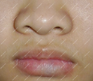 Điều trị dị dạng hồ tĩnh mạch ở niêm mạc môi đỏ bằng laser Nd:YAG 8