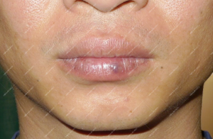 Điều trị dị dạng hồ tĩnh mạch ở niêm mạc môi đỏ bằng laser Nd:YAG 9