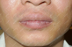 Điều trị dị dạng hồ tĩnh mạch ở niêm mạc môi đỏ bằng laser Nd:YAG 10
