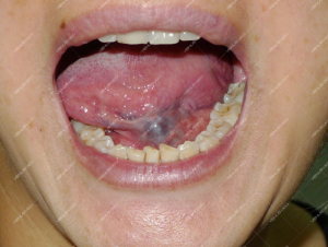 Điều trị dị dạng tĩnh mạch trong khoang miệng và niêm mạc môi đỏ bằng laser Nd:YAG xung dài 3