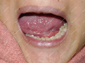 Điều trị dị dạng tĩnh mạch trong khoang miệng và niêm mạc môi đỏ bằng laser Nd:YAG xung dài 4