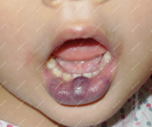 Điều trị dị dạng tĩnh mạch trong khoang miệng và niêm mạc môi đỏ bằng laser Nd:YAG xung dài 5