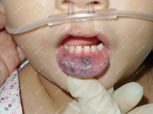 Điều trị dị dạng tĩnh mạch trong khoang miệng và niêm mạc môi đỏ bằng laser Nd:YAG xung dài 6