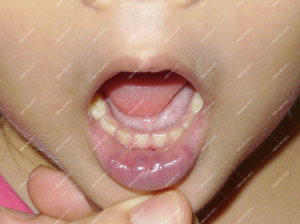 Điều trị dị dạng tĩnh mạch trong khoang miệng và niêm mạc môi đỏ bằng laser Nd:YAG xung dài 7