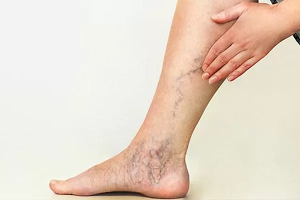 Giãn mao mạch ở chân có nguy hiểm không