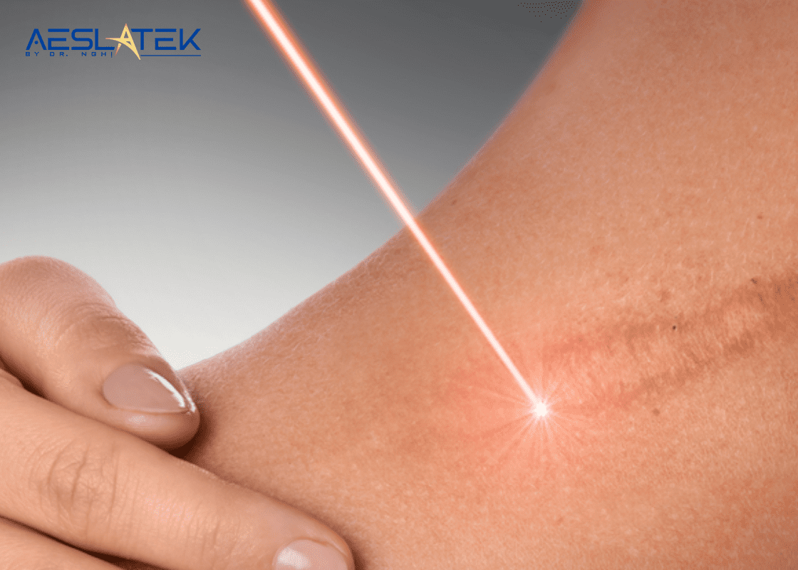 Bắn sẹo lồi bằng tia laser là phương pháp hiệu quả và an toàn