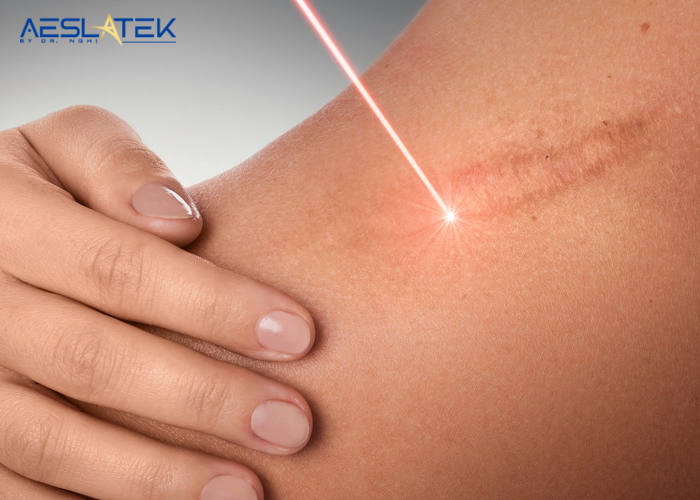 Công nghệ laser đem đến hiệu quả trị sẹo lồi gần như tuyệt đối