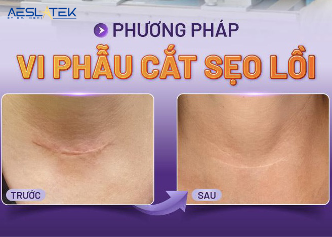 Cắt sẹo lồi bao nhiêu tiền? Cắt sẹo lồi tại Thẩm Mỹ Aeslatek có đắt không? 3 Cắt sẹo lồi bao nhiêu tiền tại Thẩm mỹ Aestetak