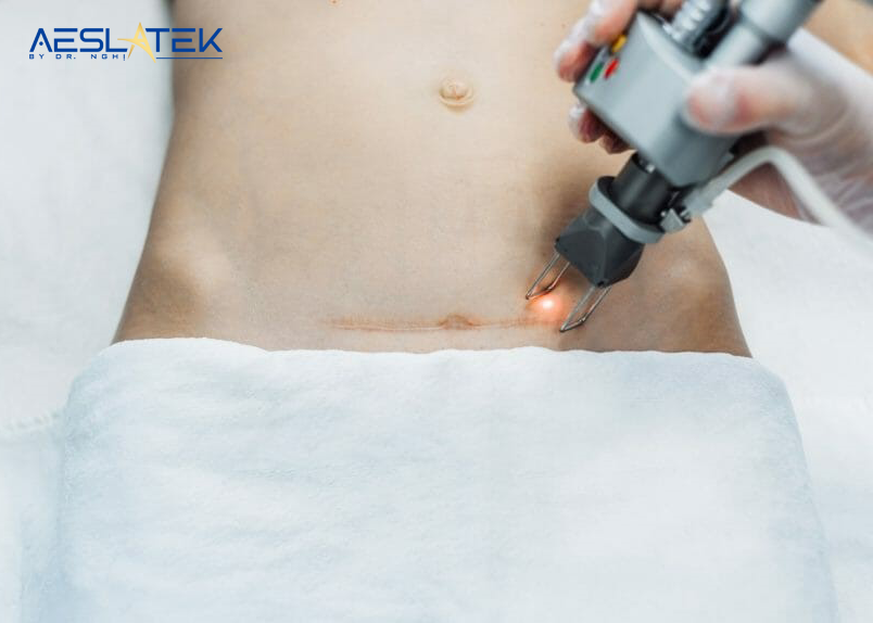 Sử dụng công nghệ laser trị sẹo lồi hiệu quả lên đến 90%