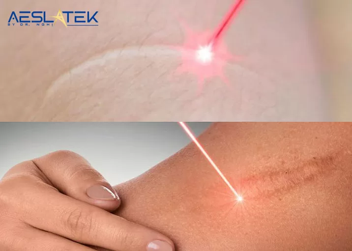 Trị sẹo hiệu quả hơn với công nghệ laser hiện đại