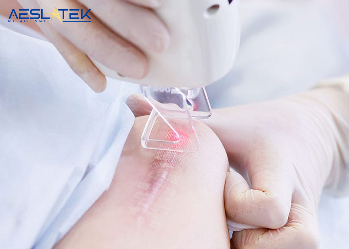Laser là phương pháp điều trị sẹo lồi tối ưu với hiệu quả cao được nhiều chuyên gia khuyên dùng