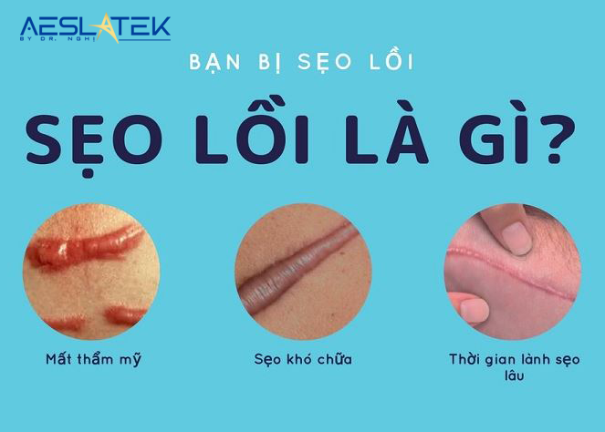 Sẹo lồi là gì? Sẹo lồi có điều trị hết được không? 1 Sẹo lồi là gì?
