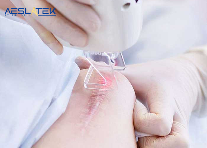 Công nghệ Laser được đánh giá là giải pháp hiệu quả nhất trong điều trị sẹo lồi 