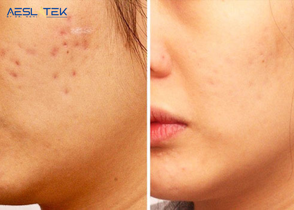 Sẹo lồi sau mụn - nỗi ám ảnh không chỉ của riêng phái đẹp 2 Phương pháp điều trị sẹo lồi hiện đại