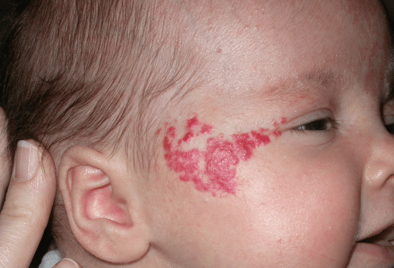 U máu thường xuất hiện ở trẻ nhỏ
