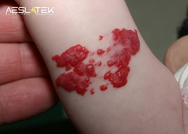 U máu trên bề mặt da rất phổ biến ở trẻ sơ sinh
