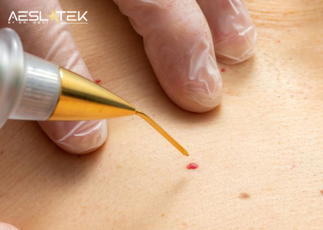 Sử dụng tia laser có thể loại bỏ hoàn toàn u máu anh đào