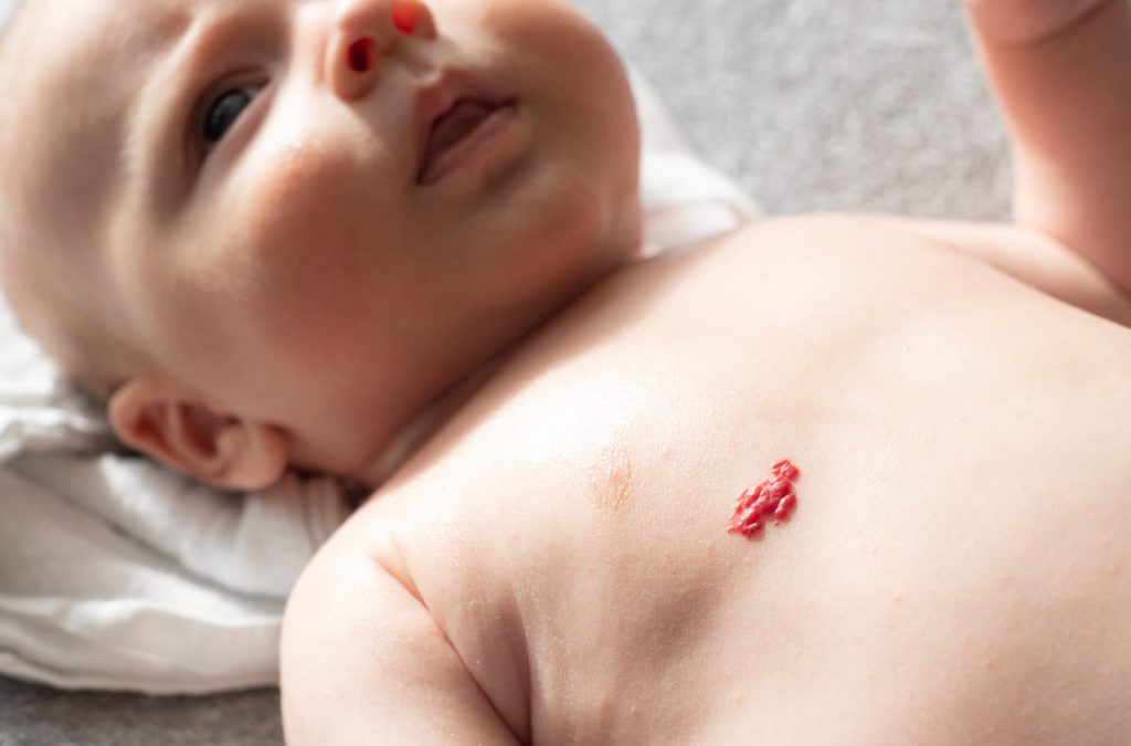 U máu là dạng bệnh lý thường gặp ở trẻ sơ sinh