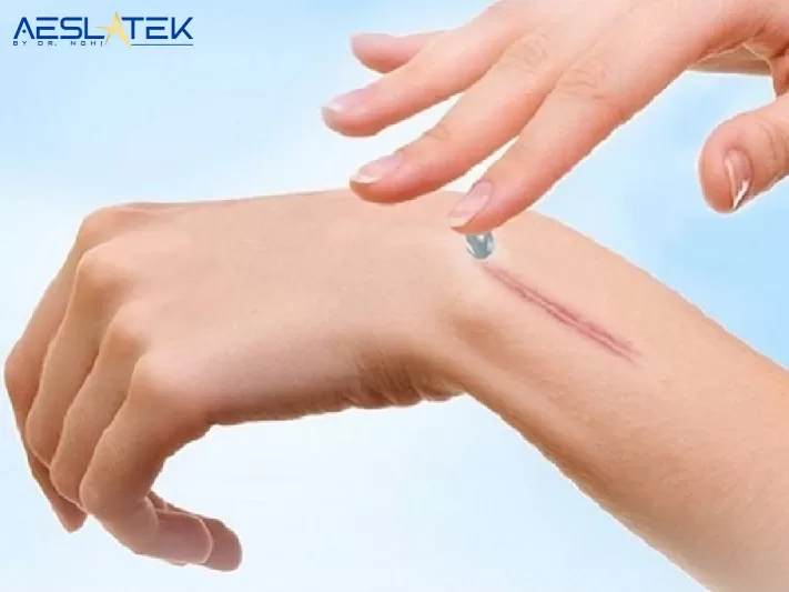 Sẹo lồi rất dễ hình thành khi tổn thương trên da