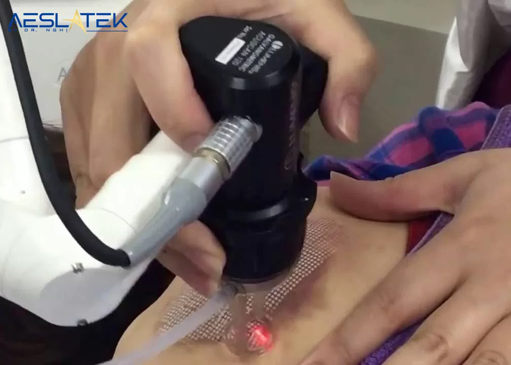 Laser có thể điều trị sẹo lồi đỏ hiệu quả, hạn chế tái phát