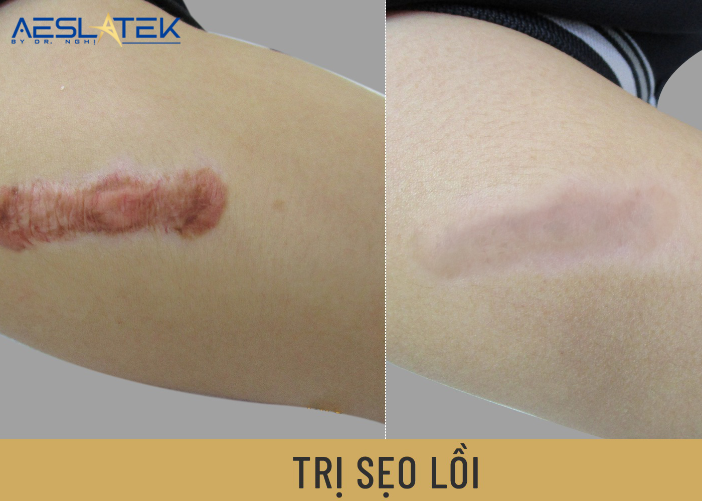 Sẹo lồi làm sao hết? Những nguyên tắc cần biết để khắc phục 1 Sẹo lồi làm sao hết và những điều bạn cần biết