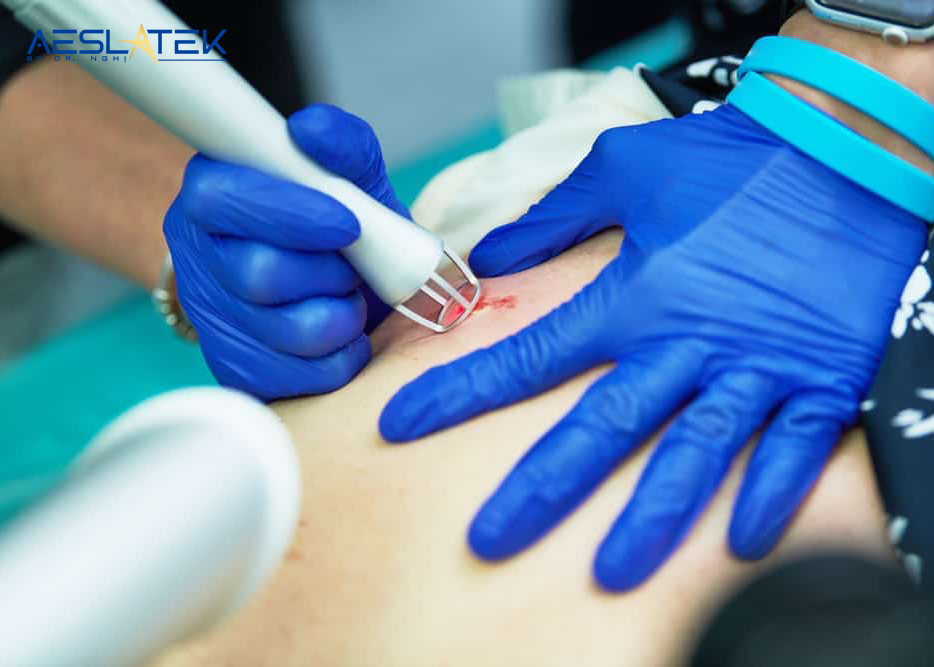Phương pháp trị sẹo công nghệ cao được chuyên gia khuyến cáo