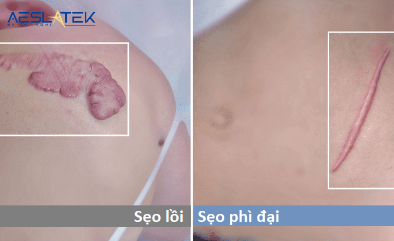 Sẹo lồi khác gì so với sẹo lồi phì đại