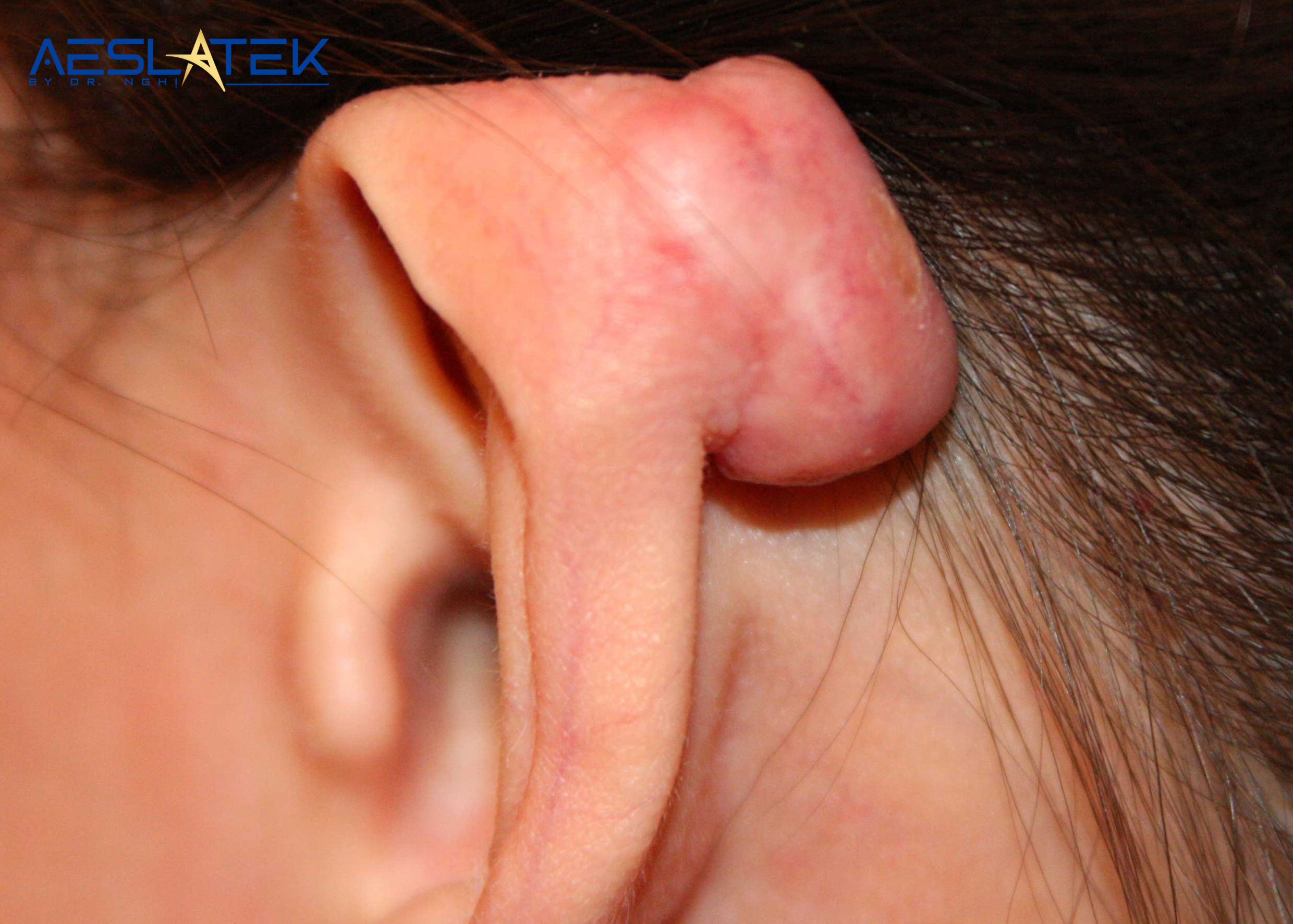 Sẹo lồi ở vành tai có xu hướng phát triển lớn