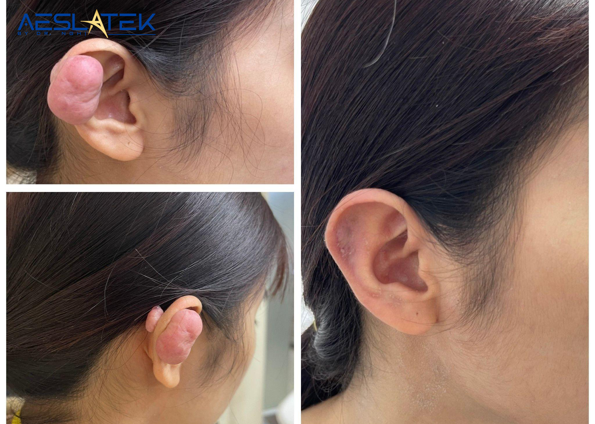 Các cách chữa sẹo lồi ở vành tai phổ biến hiện nay