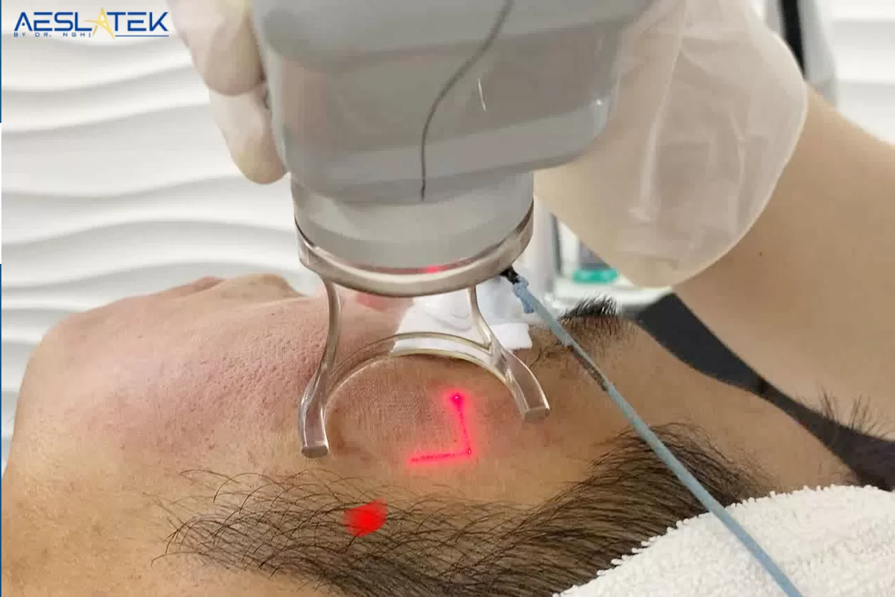 Công nghệ laser giúp trị sẹo rỗ hiệu quả và không tái phát
