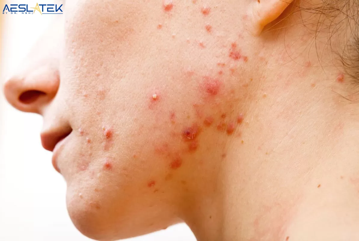 Mụn viêm hình thành do sự phát triển của vi khuẩn P. acnes