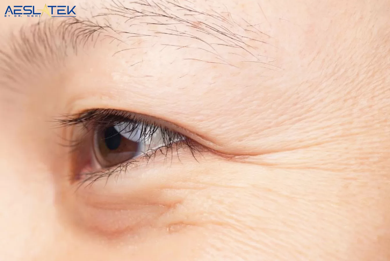 Vùng da quanh mắt rất dễ bị lão hóa làm giảm đi thần thái rạng rỡ của bạn