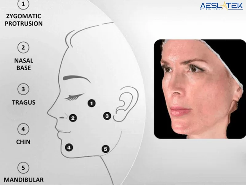 Trẻ hóa da bằng Profhilo giúp dưỡng chất được phân bố đồng đều trên toàn gương mặt