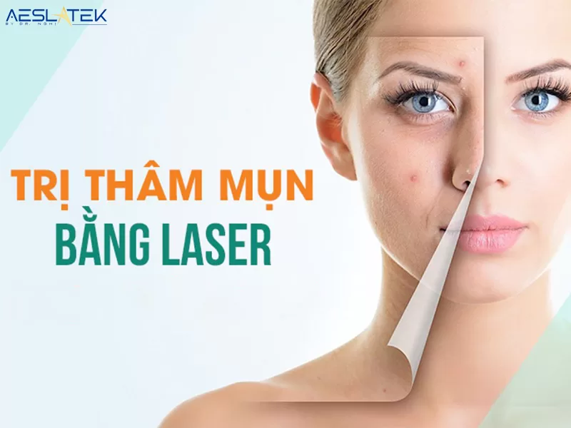 Làn da cải thiện rõ rệt sau liệu trình laser trị thâm mụn